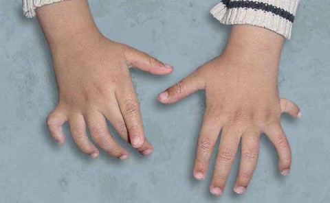 polydactyly