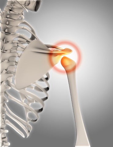 recurrent-shoulder-dislocation