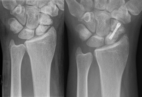 scaphoid-fracture