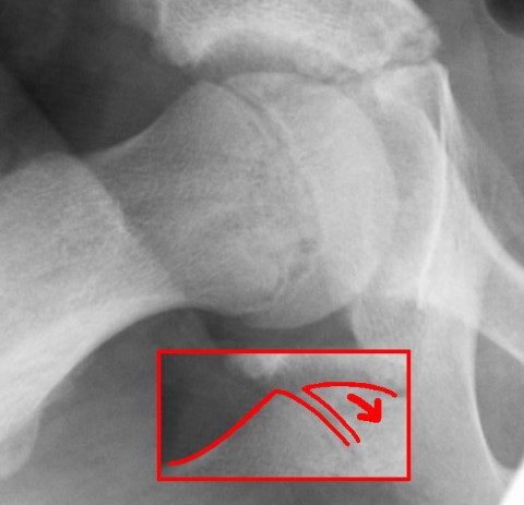 slipped-capital-femoral-epiphysis-SCFE